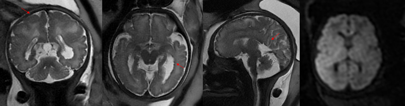 cystic structure behind the third ventricle of the fetus