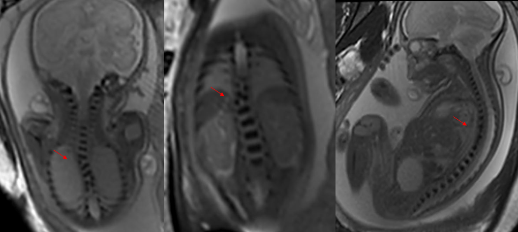 abnormal vertebral bodies echo of the fetus’ spine
Imaging diagnosis