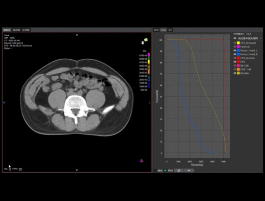 Automated Planning in 2 Minutes<br/>No Changes Required to Meet Clinical Requirements-pc